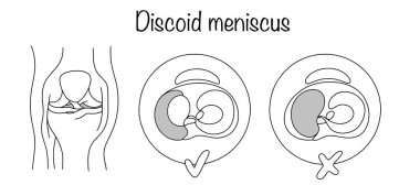 A developmental anomaly in which the cartilaginous layer of the knee joint has an atypical structure. simple illustration with healthy knee meniscus and discoid meniscus. Black and white illustration. clipart