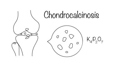 Chondrocalcinosis. Potasyum pirofosfat tuzlarının eklemlerde yavaş yavaş biriktiği bir hastalık. Tuz birikintileriyle çizilmiş siyah bir eklem. Basit vektör illüstrasyonu. 