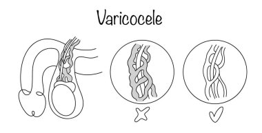 Varicose veins of the spermatic cord that carry blood from the testicle. Hand-drawn male genitalia with and without varicocele. Medical vector on white background.