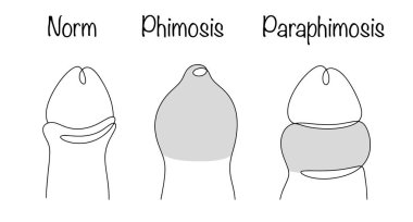 Phimosis ve parafimoz. Sünnet derisinin dış halkasının sünnet derisi ya da daralmasıyla karakterize edilen akut bir patoloji. Erkek sağlığıyla ilgili ürolojik sorunlar. Vektör.