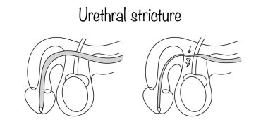 Urethral daralma. Üretral kanalın çapındaki patolojik düşüş. Elle çizilmiş sağlıklı erkek üreme sistemi ve üretral daralma. Tıbbi alanda kullanmak için vektör illüstrasyonu. 