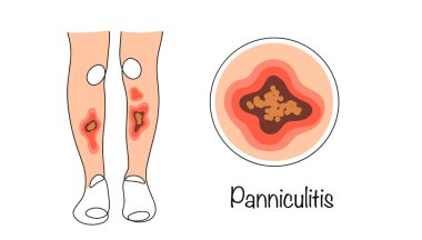 Deri altı yağ dokusunu etkileyen iltihaplı bir hastalığın kronik ilerlemesi. Paniklemeden etkilenen bacakların renkli vektör çizimi. Tıbbi renk vektörü.