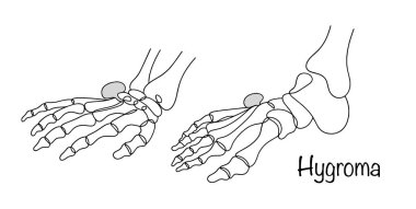 Higroma. Eklem kapsülü ya da tendon kılıfından çıkan kistik iyi huylu bir oluşum. El ve ayakta higroma tespit edildi. Beyaz arkaplanda izole edilmiş vektör.