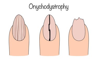 Tırnak tabakasında patolojik değişiklikler var. Boylam oyukları ve çatlakları olan bir kadın tırnağı. Onikoliz belirtileri var. Vektör illüstrasyonu.