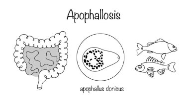 Apophallosis. Helminthiasis that affects humans by eating contaminated river fish. Medical vector illustration on the theme of diseases snatched by parasites.  clipart