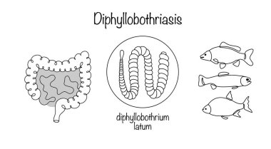 Diphyllobothriasis. Parasitic infestation by tapeworms with intestinal damage. Hand-drawn disease diagram. Most often, a person becomes infected by eating infected fish. Vector illustration. clipart