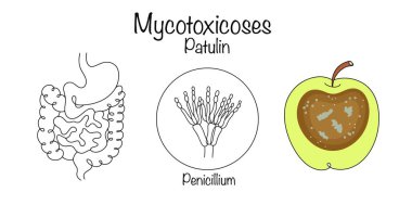 Patulin is formed in moldy fruits and has a carcinogenic and toxic effect on the gastrointestinal tract. A drawn diagram of the disease and a spoiled apple as the cause of the disease. Vector. clipart