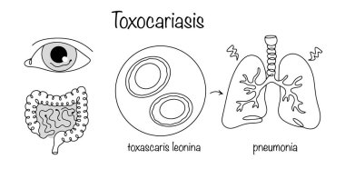 Helminthiasis, göz ve bağırsak biçimlerinde insanlarda kendini gösterir. Elle çizilmiş zehirlenme, nedensel etken ve sonuç. Siyah ve beyaz vektör.