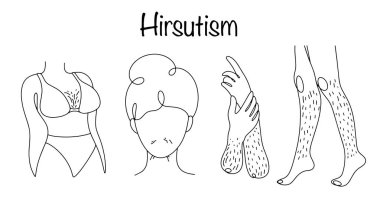 Hirsutizm. Endokrin sistem patolojisinin bir semptomu, yüzdeki ve vücuttaki diğer bölgelerdeki aşırı kıllarla karakterize edilir. El çizimi hirsutizm belirtileri. Vektör illüstrasyonu.
