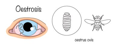 Entomosis caused by nasopharyngeal gadfly. Bodfly larvae often infect the eyes, causing ophthalmomyasis. Hand-drawn illustration on a medical theme. Oestrosis. clipart