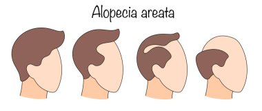 Erkek desenli kelliğin aşamalarını gösteren basit bir renk vektör çizimi. Saç dökülmesi doğal bir yaşlanma süreci ya da gençlik sorunu olarak görülür. Alopecia areata.