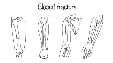 Kapalı kırık. Kemik dokusunun bütünlüğünün bozulması. Deride ve mukoza zarlarında hasar yok. Kapalı kemik kırıkları için çizgili seçenekler. Tıbbi vektör.