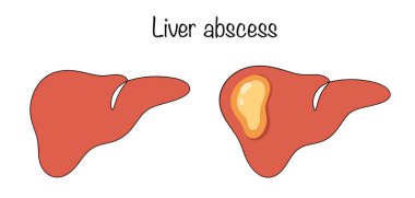 Karaciğer apsesi. Karaciğer parenksimasının kalınlığında bir oyuk, kapsülle sınırlı, irinli kütlelerle dolu. Karaciğer ve karaciğer apsesi. Farklı kullanımlar için renkli vektör.