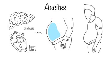 A pathological condition in which there is an accumulation of free fluid in the abdominal cavity due to cirrhosis of the liver or heart failure. A man with manifestations of ascites. Vector. clipart