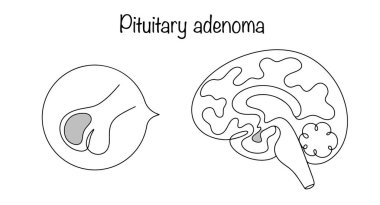 Beyin tümörü, kafatası kemiklerinin yanındaki sella turkica çukurunda bulundu. El yapımı hipofiz bezi adenomu. Tıbbi vektör çizimi. Siyah ve beyaz vektör.