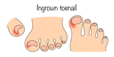 Tırnak kapağının yanal kenarına doğru büyümesi ve acının eşlik etmesi. Baş parmak tırnağının çizilmiş oniyolizi ile renk vektör çizimi. Tıbbi ve kozmetik problemi. Vektör.