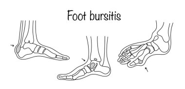 Foot bursitis. An inflammatory disease that affects the mucous membranes that are located near the joints of the foot. Hand-drawn illustrations of different manifestations of bunions. Medical vector. clipart