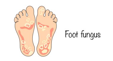 Ayak mantarı. Deri ve tırnak tabakalarını etkileyen bir mantar hastalığı. Mantar belirtileri gösteren ayaklar çizilmiş. Dermatomikoz türlerinden biri. Renk vektörü illüstrasyonu.