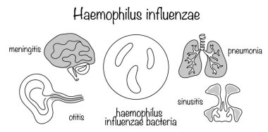 Haemophilus influenzae 'nin sebep olduğu akut bulaşıcı bir hastalık. Hemophilus influenzae enfeksiyonu solunum sistemini etkiliyor. Hastalığın nedensel faktörünün çizimi ve ana semptomlar.