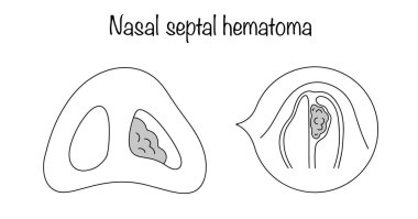 Nasal septal hematoma. Hemorrhage under the mucous membrane of the nasal septum with the formation of a hematoma. Drawn nose with hematoma of the nasal septum. Hand drawn black line illustration. clipart