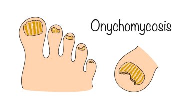 Onikomikozis. Patojenik mantar mikroorganizmalarına maruz kalmaktan kaynaklanan kronik bulaşıcı bir hastalık. Tırnak mantarını gösteren renk çizimi. Kozmetik ve tıbbi sorunlar. Vektör illüstrasyonu.