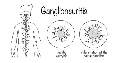Sinir sinirlerinde iltihaplı lezyon. İnsan vücudunda ana gangliyon oluşmuş. Yakınlarda sağlıklı bir ganglion ve sinir sinirlerinde iltihap var. Tıbbi alanda kullanılmak üzere illüstrasyon.