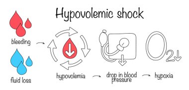 Arteryel kan hacmindeki ciddi bir eksiklikle ilgili kritik bir durum. Hipovolemik şokun gelişiminin basit bir diyagramı. Renkli tıbbi vektör.