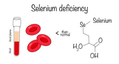 Selenyum eksikliği. Selenyum için alınan bir kan testi bu mikro elementin eksikliğini ortaya çıkardı. Farklı kullanımlar için basit vektör illüstrasyonu.