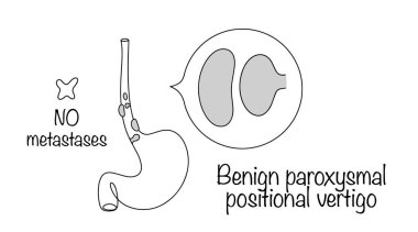 Mide bağırsağının üst kısmında büyüyen tümörler. Özofajiyal kanserden başlıca farkları metastaz olarak yayılmamaları. El çizimi vektör illüstrasyonu.