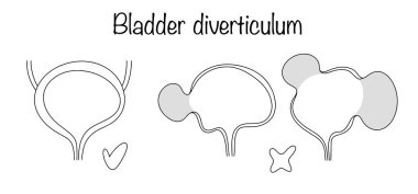 Sınırlı bir alanın uzaması? ... boynunda bir oyuk oluşumu olan idrar kesesi duvarı. Sağlıklı mesane ve deformasyon seçenekleri. Mesane divertikulumu.