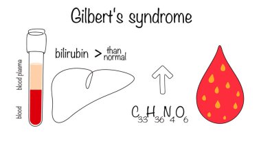 Gilbert sendromu. Kronik karaciğer patolojisi. Kan serumundaki dolaylı bilirubin seviyesinde genetik olarak belirlenmiş sürekli bir artış. Tıbbi bir tema üzerine vektör illüstrasyonu.