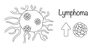 Bağışıklık sisteminin ana hücreleri olan lenfositlerin oluşturduğu kötü huylu bir tümör. Tümör çizildi ve lenfosit sayısı arttı. Çizgi çizilmiş tıbbi vektör.