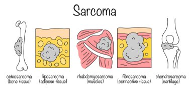 A malignant tumor that develops from the connective or soft tissues of the body, such as bones, muscles, tendons, cartilage, fatty tissue, or blood vessels. Drawn types of sarcomas. clipart