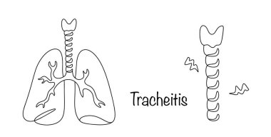 A disease of the lower respiratory system, accompanied by acute or chronic inflammation of the tracheal mucosa. Simple line illustration. Tracheitis. clipart