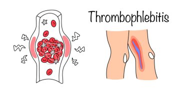 Yüzeysel damarlardan oluşan duvarlarda iltihaplanma var. Bu da kan pıhtılaşmasının oluşumuna eşlik ediyor. İçerideki kan pıhtısının çizimi ve dışarıdan nasıl göründüğü. Tıbbi vektör.