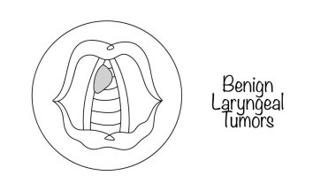 İyi huylu Laringeal Tümörler. Ses tellerinde lokalize edilmiş iyi huylu bir oluşum. El çizimi vektör tıbbi illüstrasyon.