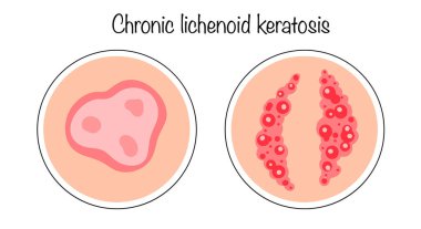 A rare skin disease manifested by the appearance of multiple red hyperkeratic papules. Hand-drawn versions of the appearance of lichenoid keratosis chronicus on the skin.  clipart