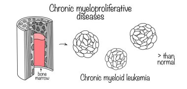 A disease in which the bone marrow produces too many white blood cells. Hand-drawn diagram of the occurrence of chronic myeloid leukemia. Vector illustration. clipart