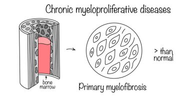 Kemik iliğinde, normal hematopoezi bozan bağ dokusunun aşırı büyümesi. Hastalığın tıbbi diyagramı. Vektör çizimi. Birincil miyelofibrosis.