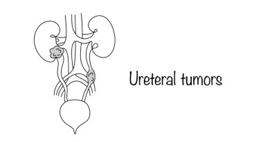 Üst idrar yolunda kötü huylu neoplazma. Bu da böbrek leğen kemiğini ve üreteri etkiler ve genişlemelerine neden olur. Tümör bölgelerinin çizimleri. Vektör çizimi. Ureteral tümörler.