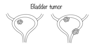 İdrar kesesi tümörü, organın içinde ya da duvarında oluşan bir neoplazmadır. İdrar kesesi tümörlerinin yerinin değişkenleri. Basit bir siyah-beyaz vektör çizimi. Mesane tümörü.