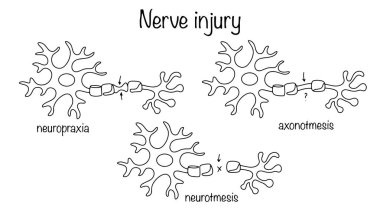 Sinir liflerinin hasar gördüğü bir durum. Sinir boyunca sinyallerin iletimini bozabilir. Nöronal hasarın ana tipleri aralıksız olarak çizilmiş. Vektör illüstrasyonu.