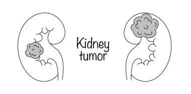 Böbrek dokusundan oluşan sıkıştırılmış bir neoplazma. Farklı yerlerde tümörlü insan böbrekleri. Tıbbi kullanım için illüstrasyon. Vektör.