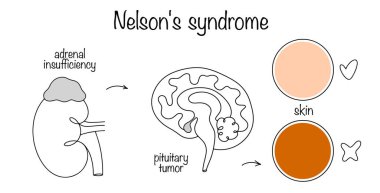 A disease characterized by chronic adrenal insufficiency, hyperpigmentation of the skin, mucous membranes and the presence of a pituitary tumor. Vector illustration. clipart