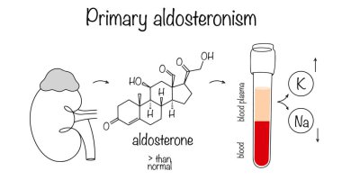 Excessive production of aldosterone by the adrenal cortex, which results in a decrease in plasma potassium and an increase in sodium. Color medical illustration. Primary aldosteronism. clipart