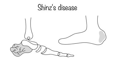 Kalkaneal tüberkülozun eklem nekrozu. Hastalığın belirtileri ortaya çıktı. Tıbbi bir tema üzerine basit bir siyah beyaz illüstrasyon. Shinz hastalığı..