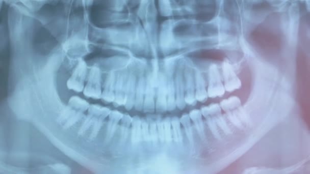 Panoramische Tandheelkundige Röntgenfoto Bij Tandarts — Stockvideo