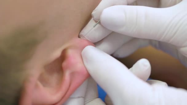 鍼治療について クリニックで鍼治療を受けている人の耳の閉鎖 — ストック動画