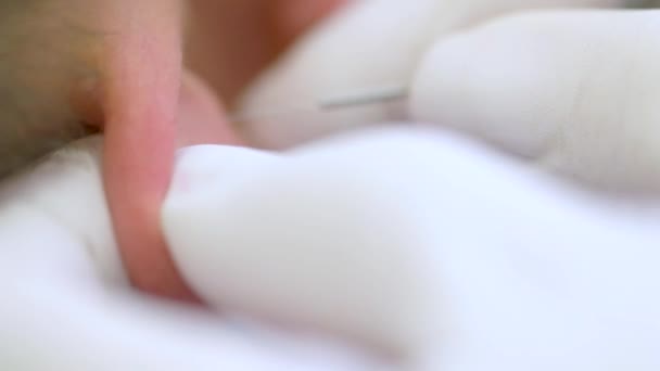 鍼治療について クリニックで鍼治療を受ける男性の耳の閉鎖 — ストック動画