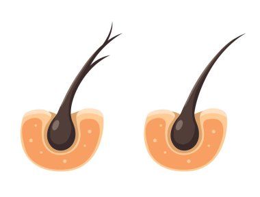 Saç Sağlıklı ve Bölünmüş Sorunlu Çizgi Film Çizim Vektörünü Bitiyor